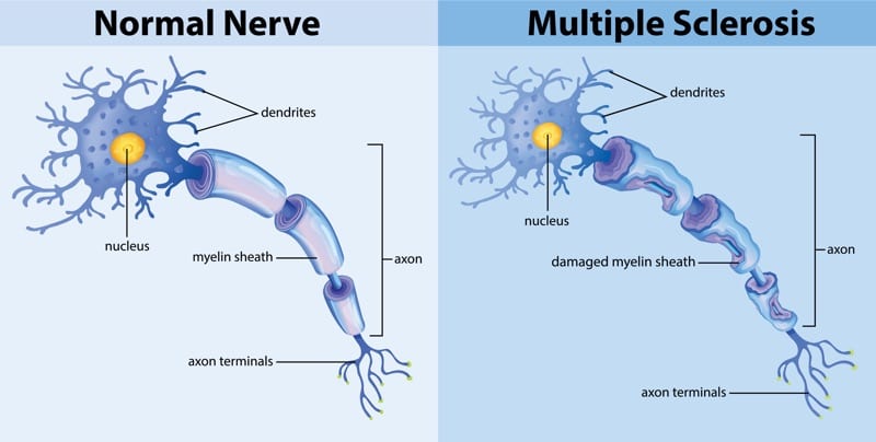 Multiple Sclerosis symptoms attacking the nerve